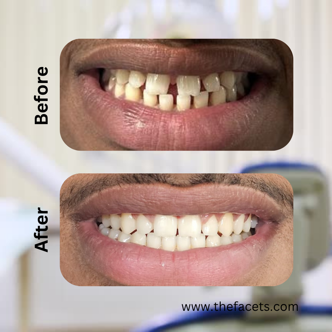 Before and after clear aligner treatment result 1